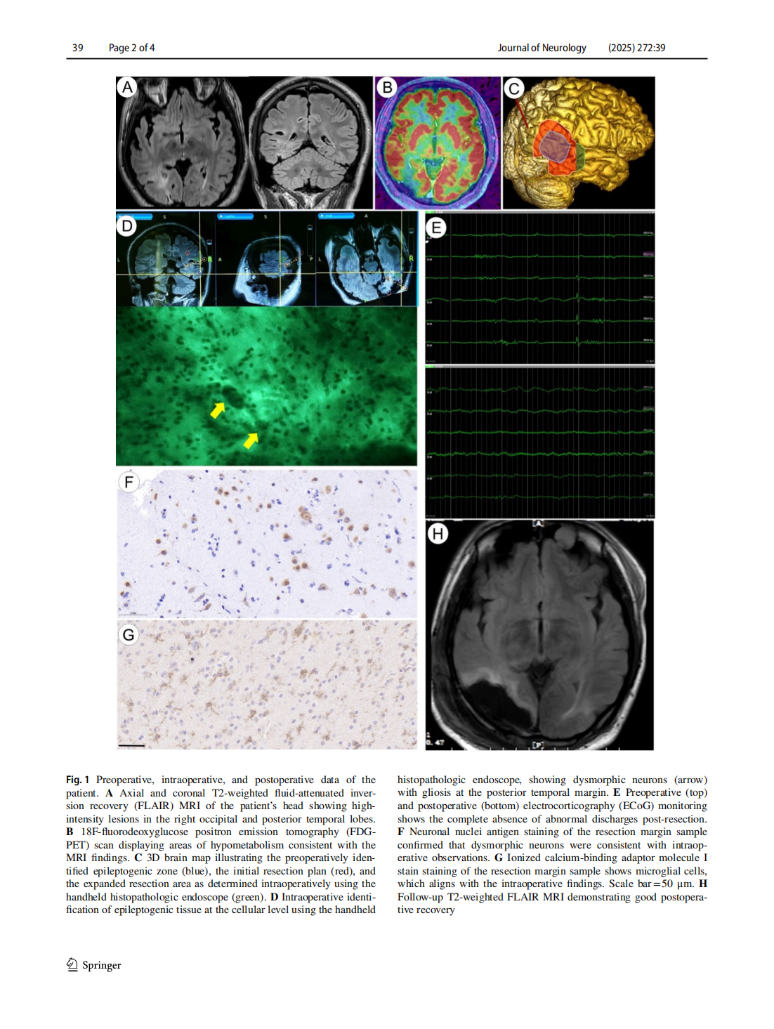 Intraoperative identifcation of epileptogenic foci using handheld  histopathologic endoscopy: a case report(图2)