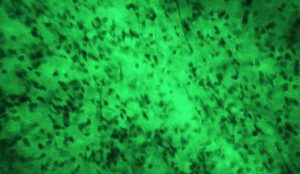 Brain Cancer