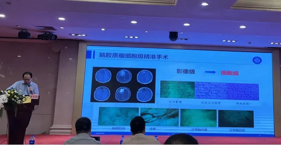 术中手持显微镜EndoSCell™助推脑胶质瘤诊疗进入细胞级精准手术时代(图5)