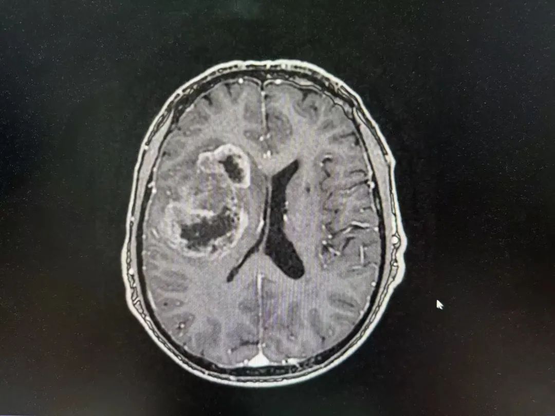 河北医大二院应用细胞级荧光导引精准技术，突破高级别胶质瘤手术的裸眼限制(图3)