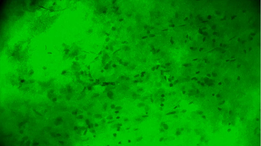胶质母细胞瘤手术新突破：河北医大二院应用EndoSCell®实现细胞级精准切除(图5)