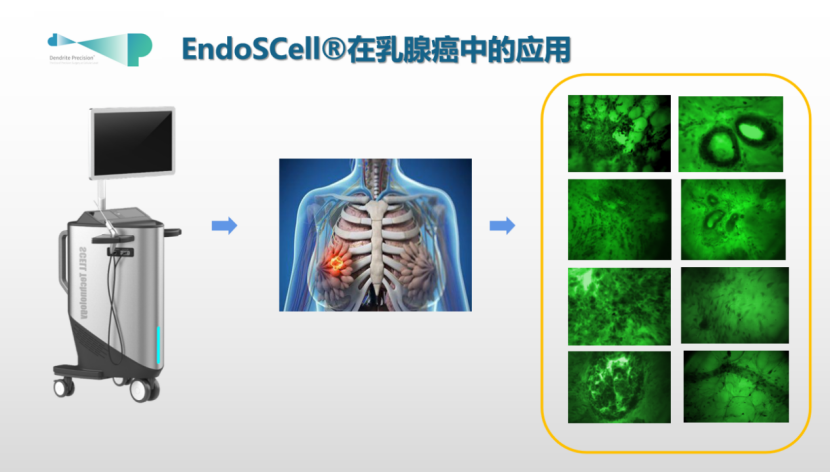 天津国际乳腺癌大会专家锐评：EndoSCell®细胞级精准手术有助提高保乳率(图3)