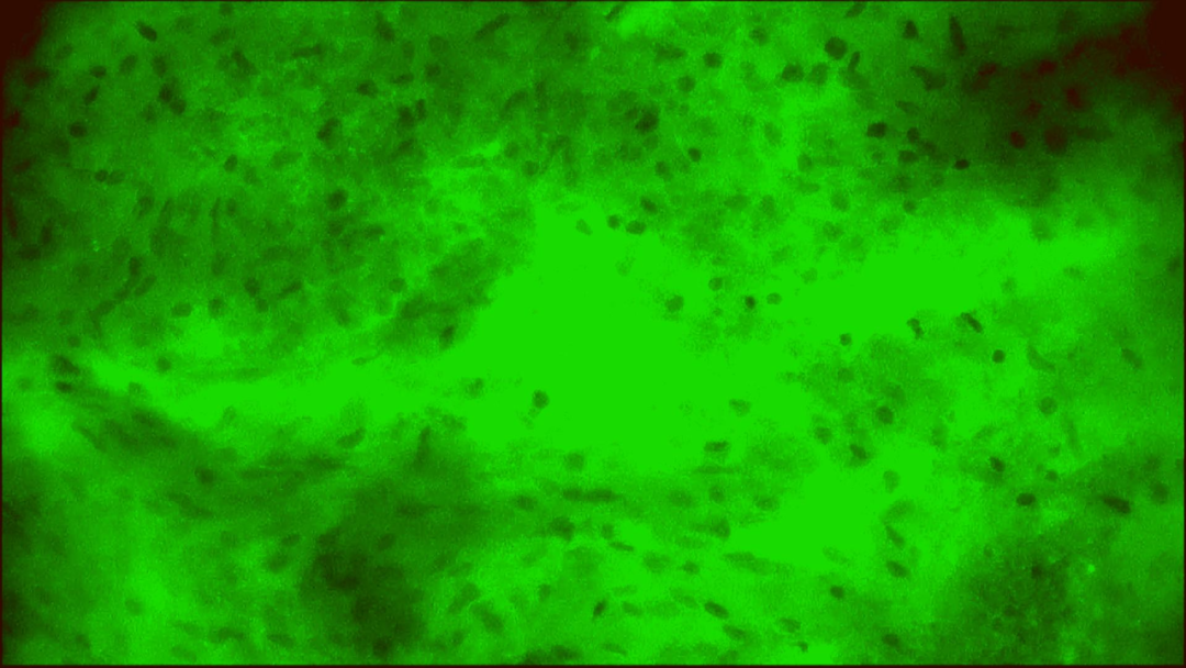 细胞级精准切除！河北医大二院应用EndoSCell®实现胶质瘤手术新突破(图8)