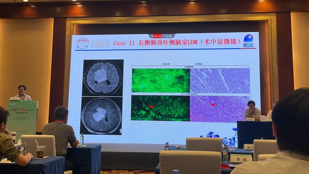 1200倍+放大直视肿瘤细胞！全球首创细胞级荧光导引技术EndoSCell®亮相华西神外学术周(图5)
